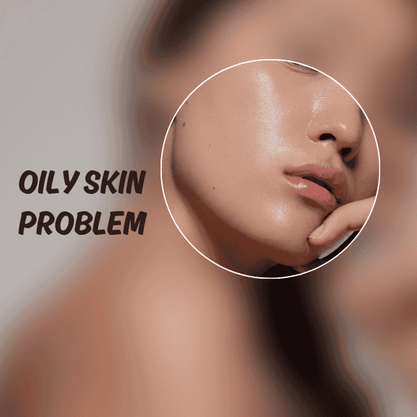 Oily Skin
